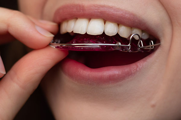 A person with braces eating a piece of gum.