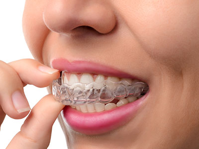 An adult woman wearing clear braces with a focus on her mouth and teeth.