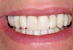 The image shows a close-up of a person s teeth with a bright smile, highlighting their dental hygiene.