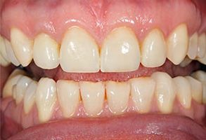 The image shows a close-up view of a person s teeth with a focus on their yellowed appearance.