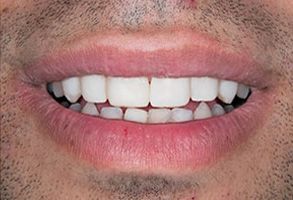 A close-up photo of a person s smiling mouth with white teeth, showcasing a dental implant on one side.