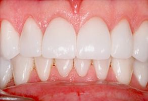 The image shows a close-up view of a person s teeth with a focus on their bright white color and clean appearance, set against a contrasting darker background.