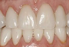 The image shows a close-up view of a person s teeth with a focus on cosmetic dentistry, specifically highlighting the process of bleaching and possibly dental implants or veneers.