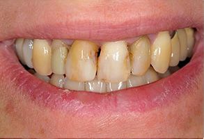 The image shows a person with a smile displaying yellowed teeth, which suggests poor oral hygiene or possible dental issues.