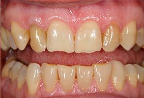 The image displays a close-up view of a person s teeth with an emphasis on dental care, possibly for educational or promotional purposes.