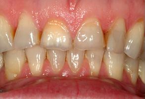 The image shows a close-up view of a person s teeth with an emphasis on dental health issues such as discoloration, staining, and potential decay.