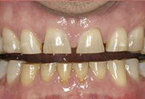 The image shows a close-up view of a person s teeth with visible staining and discoloration, particularly noticeable on the front teeth, which appear to be yellowed.